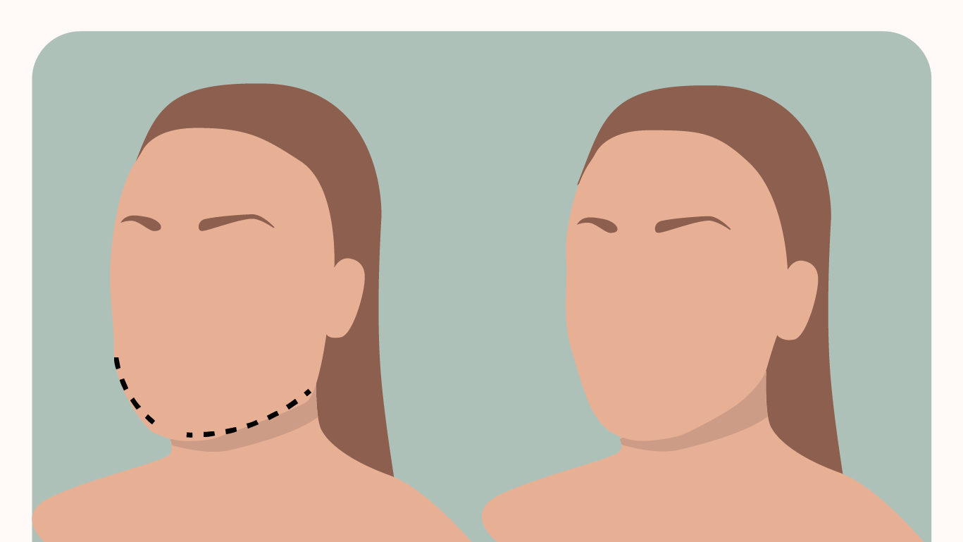 An illustration depicting the results of jaw and chin feminization surgery.